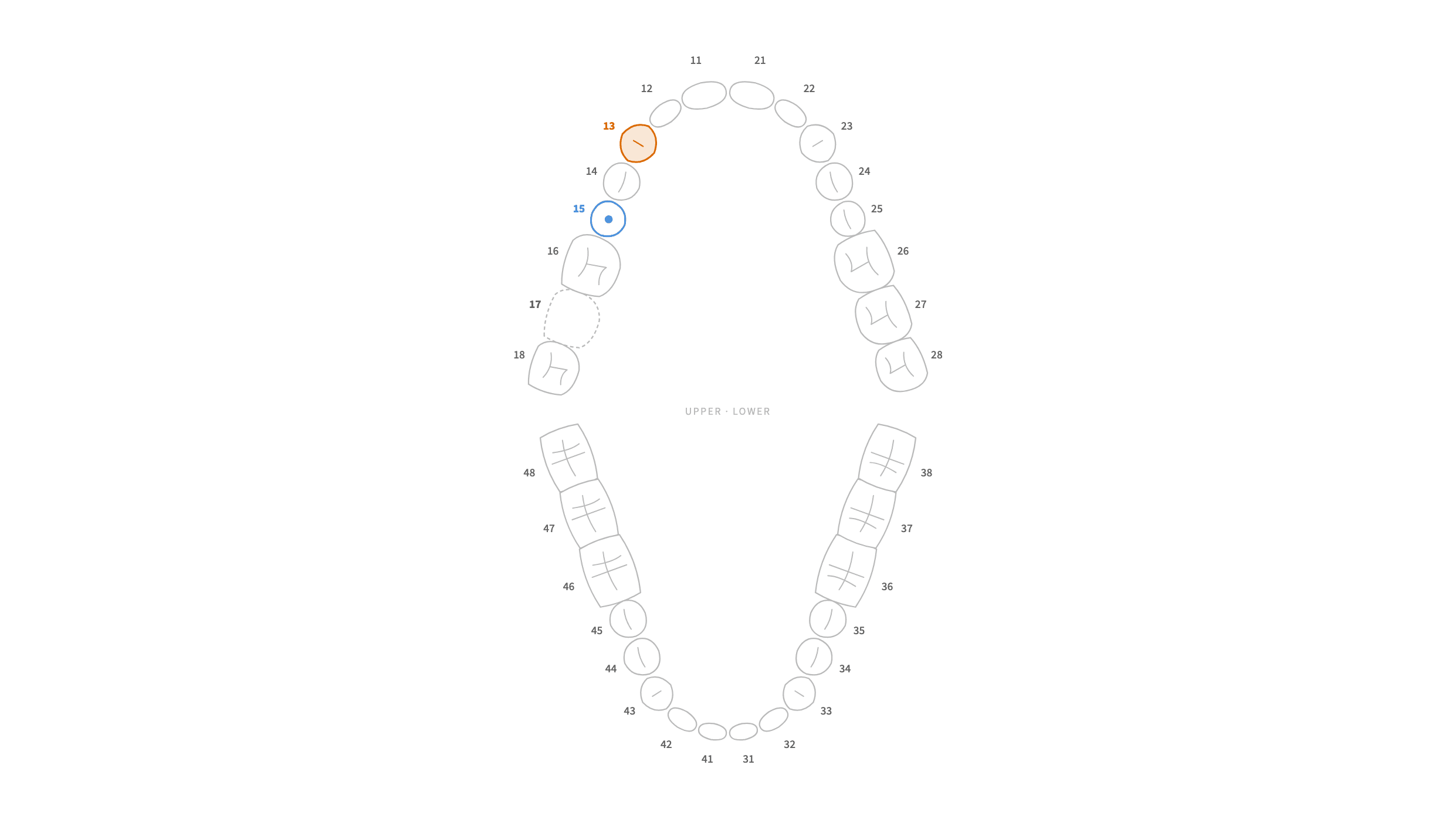 Dentlog tooth map showing every tooth, with the dictated changes highlighted